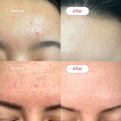 S.A Serum – Salicylic Acid 30ml | Advanced Acne & Peeling Treatment